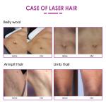 No Pain Portable Permanent Painless 755 808 1064 Hair Removal Laser Epilator