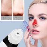 1080p Hd Home Beauty Equipment For All Skin Treatment Wireless Visual Blackhead