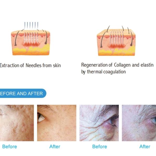 Professional Tip Pin 25pins 49 Pins Invasive Needle Free Skin Microneedle Rf Machine Gold Replacement Handle