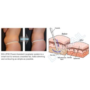 Liposuction Cavitation Slimming Machine Power Assisted