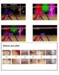 Q Switched Laser Tattoo Removal Machine