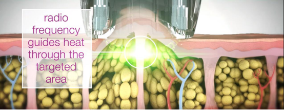 Touchscreen 5 In 1 vacuum cavitation Machine For Stretch Marks