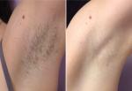 how to remove unwanted hair | ipl Shr super hair removal machine Forimi