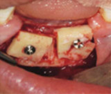 Dmetec Surgystar Ultrasonic Piezo Implant Bone Surgery,Dental Implant