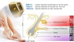 Palladium Bar Imported From Germany Diode Laser Hair Removal Machine Spot Size