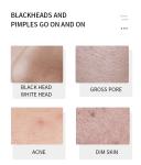 Soften Lackhead Derived Essence Face Serum Blackhead Remover Serum