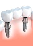 OEM Dental Crown Bridge Good Biocompatibility Smooth Surface Make Smile Sweeter