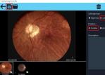 2560 X 1920 Pixels Digital Fundus Camera