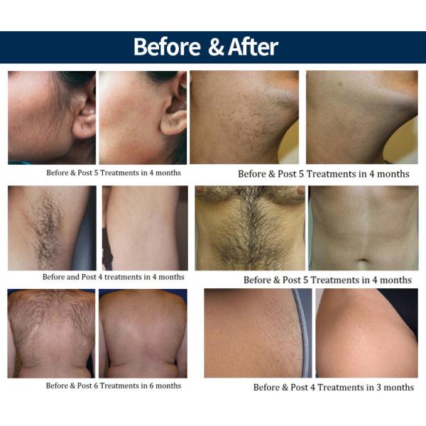 808 nm Permanent Diode Laser Hair Removal Machine Spot Size Changeable Salon use Pain Free