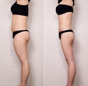 400 W Portable Liposonix Hifu Machine With 500000 Shot Times