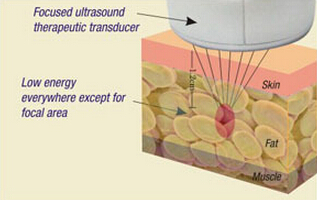 400 W Portable Liposonix Hifu Machine With 500000 Shot Times