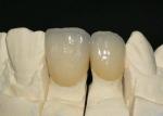 Smooth Surface PFM Metal-Ceramic Crown Corrosion Resistant