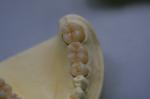 Dental Laboratory Zirconium Oxide Porcelain Zirconia Dental Crown With Ceramic