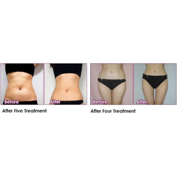 Korea The Red Lipolytic Inection Burning Fat Solution For Belly Body