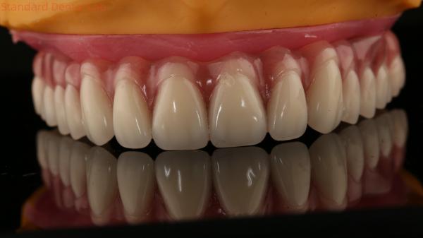 Acrylic Partial Implant Over Denture Titianium Bar Full Denture Teeth Set Up
