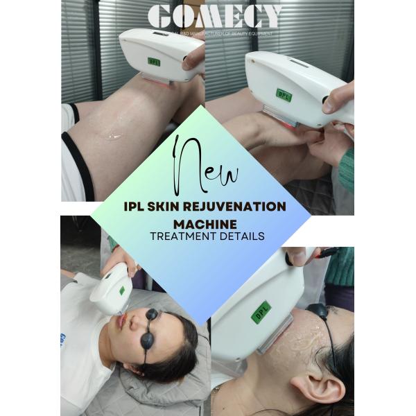 1000W Ipl Shr Laser Machine For Freckle And Vascular Lesions Removal