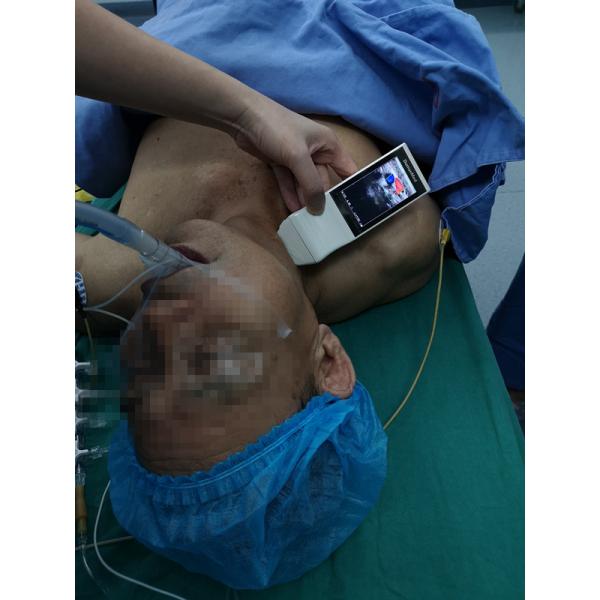 Wireless Linear Probe High Frequency Probe Special Tool for Visual Puncture Guidance Integrated Handheld Ultrasound Scanner