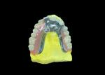 Enhance Your Smile Natural-looking PFM Crown bridge and Removable Dentures Combo