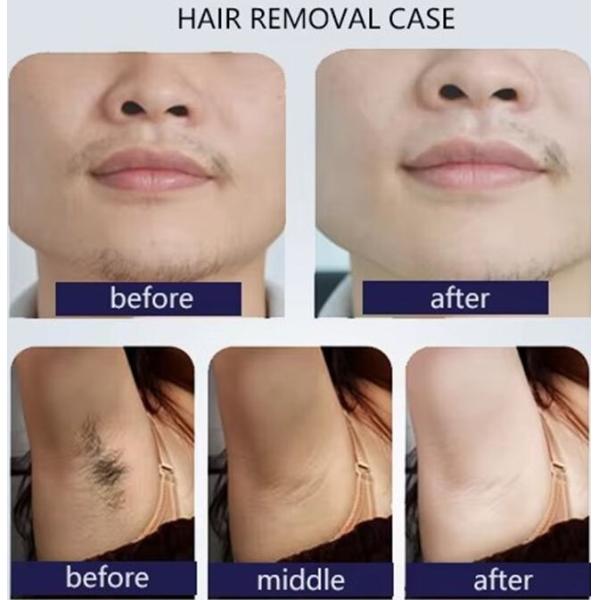 Diode Laser Hair Removal Skin Rejuvenation Beauty Machine Pico Laser 2 In 1