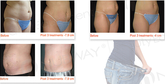 best price high intensity focused ultrasound technology slimming machine for sale