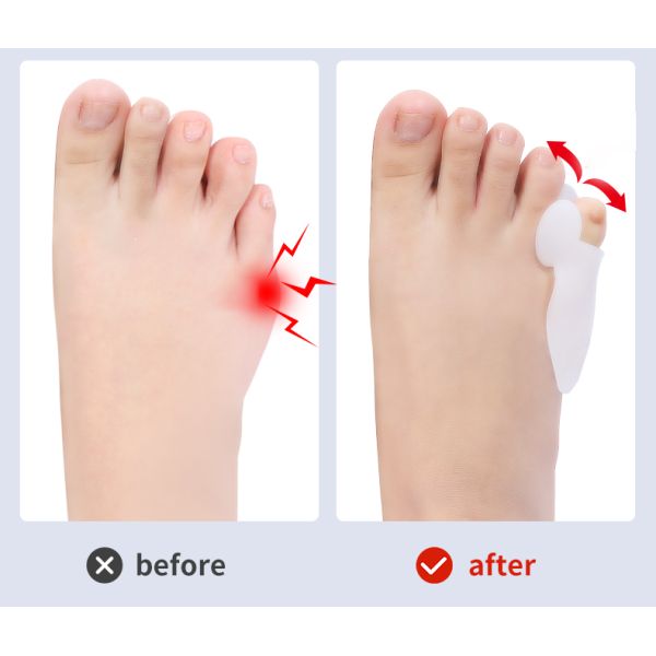 Silicone Bunion Corrector Set , Bunion Corrector Toe Separator