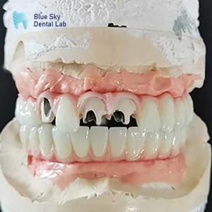 Wholesale Titanium Malo Bridge Implant Bridge Without Multi Unit Abutment Cementable from china suppliers