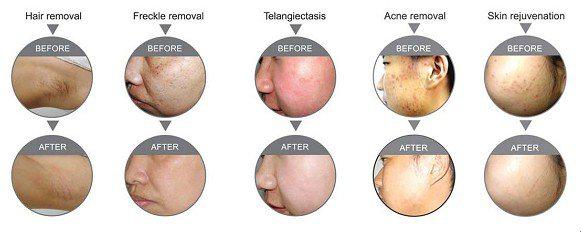 Small 800w Acne / Pigment IPL Hair Removal Machines Salon Beauty Equipment