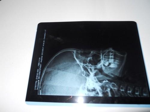 KND-A Environment friendly Medical Dry Imaging Film For X Ray Examination On