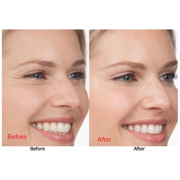 21G VSORB PDO Polydioxanone Remove Naturally Swollen Eyes