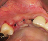 Dmetec Surgystar Ultrasonic Piezo Implant Bone Surgery,Dental Implant
