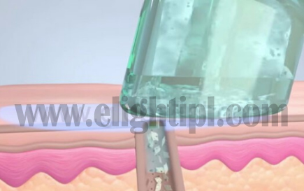 Jet Clear Facial Machine Water Oxygen Jet Peel Machine Skin Rejuvenation Machine