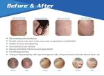 newest vertical 10.4 inch touch screen Laser Resurfacing Machine Fractional