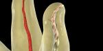 Heat Activation Dental Golden Pro-Taper Files High Flexibility For Curved Canals