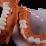 Lithium Dicilicate layer Ivoclar Emax Zirconia Laminate Veneers Translucent OEM