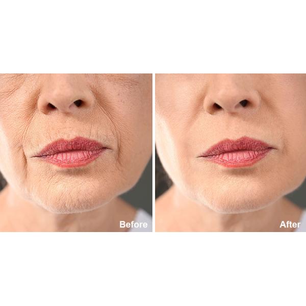 Cold Hammer Tecar RF Machine Radio Frequency Diathermy Face Lift Machine