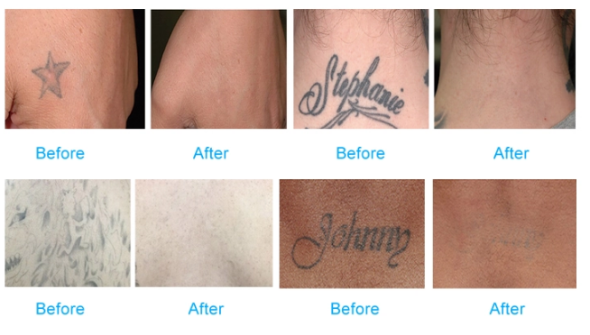 New design pico laser q switch laser tattoo removal removal scar machine
