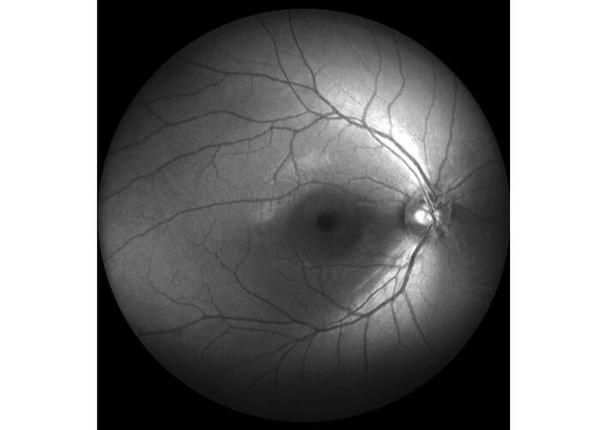 Ultra-wide Field Laser Scanning Retina Angiograph Digital Ophthalmic Equipment With Optical Zoom 100°/60°/30°