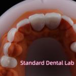 Abrasion Resistant Emax Zirconia Laminate Veneers Incisal Translucency