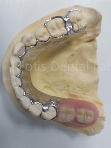 Wholesale Replace Missing Teeth Removable Partial Denture Dental Prosthesis Flexible Design from china suppliers
