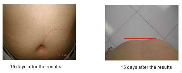 Non Invasive Body Contouring Machine , Body Freeze Machine Remove Surplus Fat