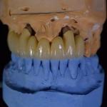FDA PFM Crown Porcelain fused to Metal Crown