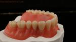 Dentsply Lucitone 199 Acrylic Denture For Full Arch Natural Look