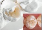 Natural Looking Ceramic Inlays and Onlays for Precise Dental Restoration from