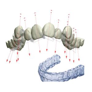 Wholesale Retainer Braces FDA Fixed Orthodontic Appliance With 3D from china suppliers