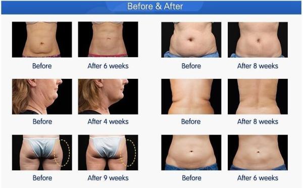 CE / FDA approved cooling max -15'C safety lipocryo cryolipolysis slimming fat