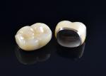High Durability Biocompatible Porcelain Fused To Metal Crown Precise Fit Custom