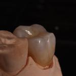 Full Contour Translucent Zirconia Crown for Aesthetically Pleasing Results