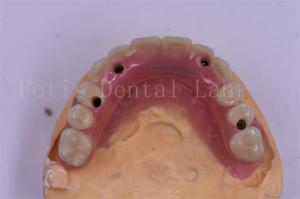 Wholesale Dental Implant Titanium Tooth Crown Precision Fit Custom Design from china suppliers