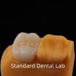 5-Year Guarantee Full Contour Zirconia Crown for Molar Teeth Noritake Porcelain