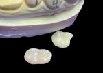 IPS e.max Ceramic Inlays and Onlays for Molar Restoration Natural Aesthetic and